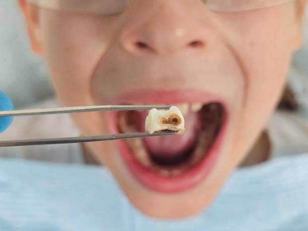 Best Emergency Tooth Extraction in Neah Bay, WA